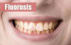 flurosis teeth