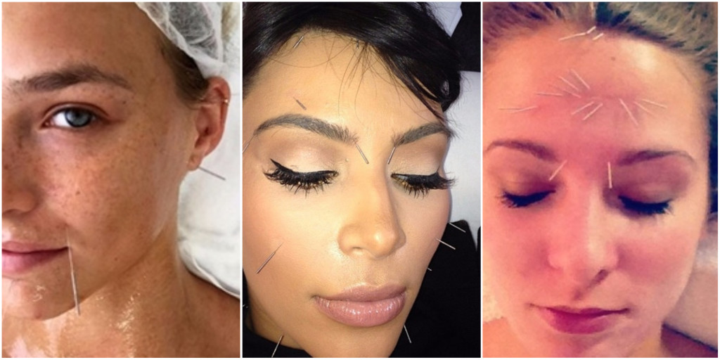 celebrities facial acupuncture 1024x512