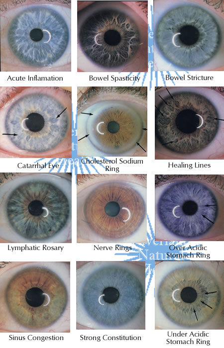 Episode 16: Why do Kayser-Fleischer rings form in the cornea in Wilson  disease? – The Curious Clinicians