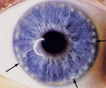 Main Iris Markings & Rings - Carahealth